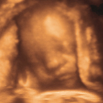 3-D Ultrasound Image